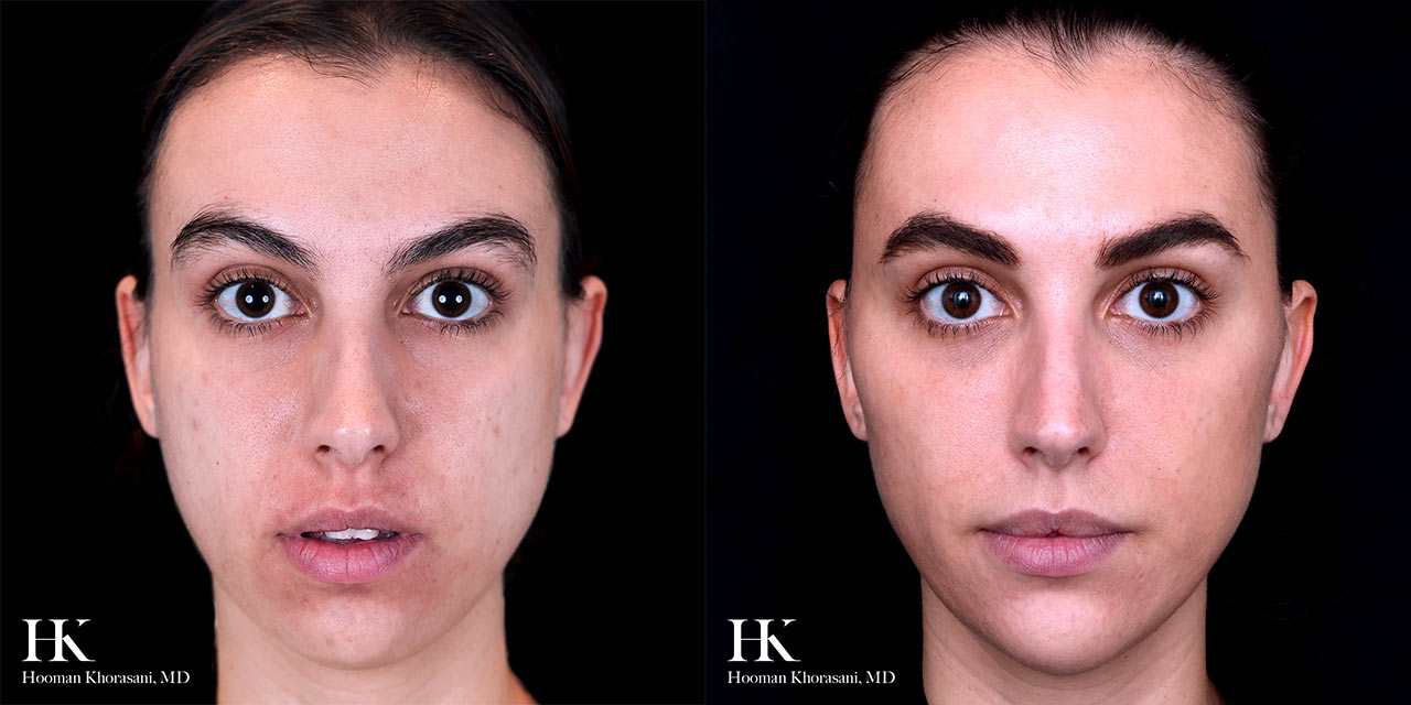 Facial contouring surgery before and after: See real results and transformations.