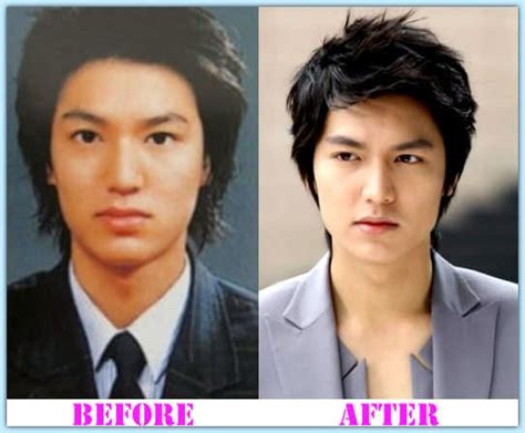 Lee Min Ho Plastic Surgery: Fans Debate If Hes Changed His Looks.