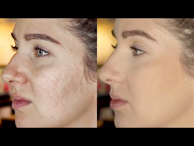 Acne Scar Actor Tips: Makeup and Skincare for the Big Screen.