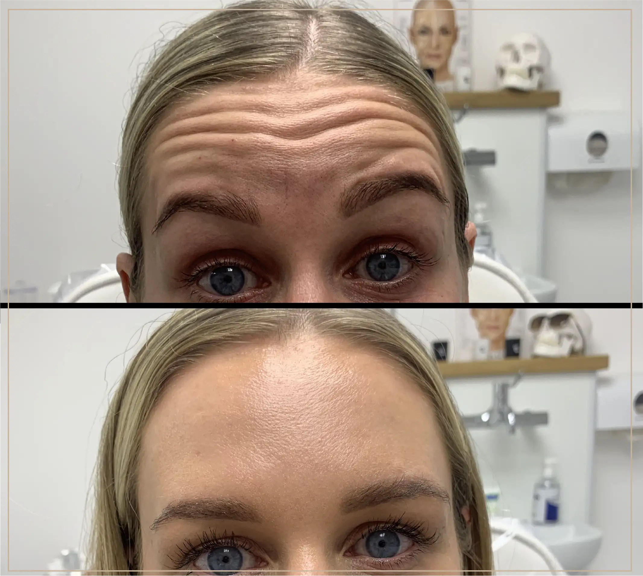 How long does Botox last? Understand these key factors that truly determine its duration.