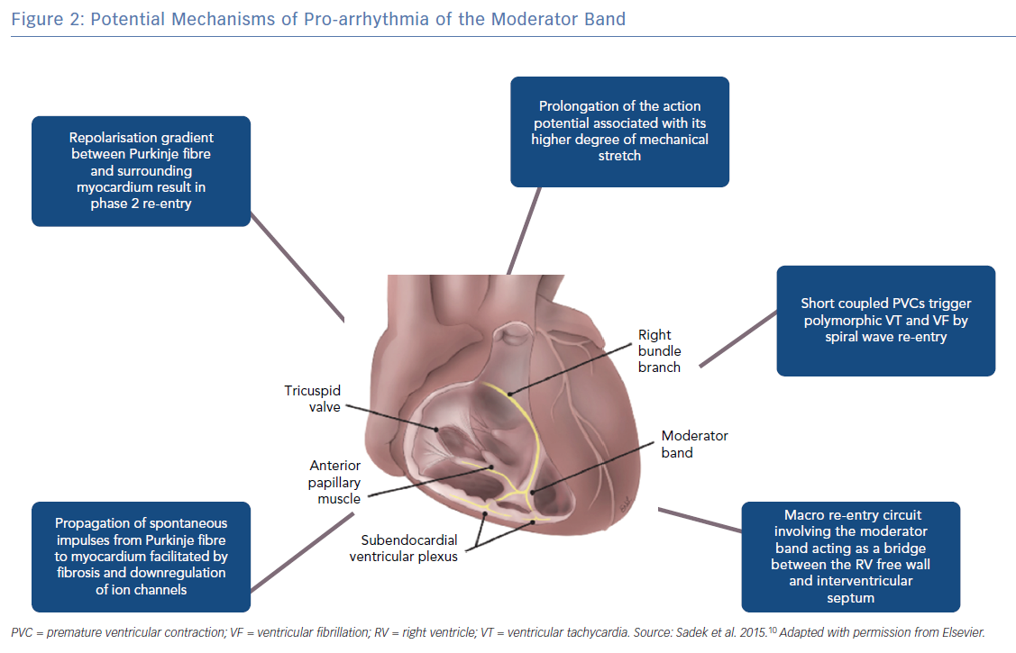 Why is moderator band function important? It plays a big role in preventing heart overstretching.