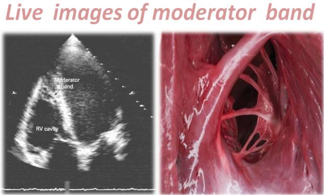 Why is moderator band function important? It plays a big role in preventing heart overstretching.
