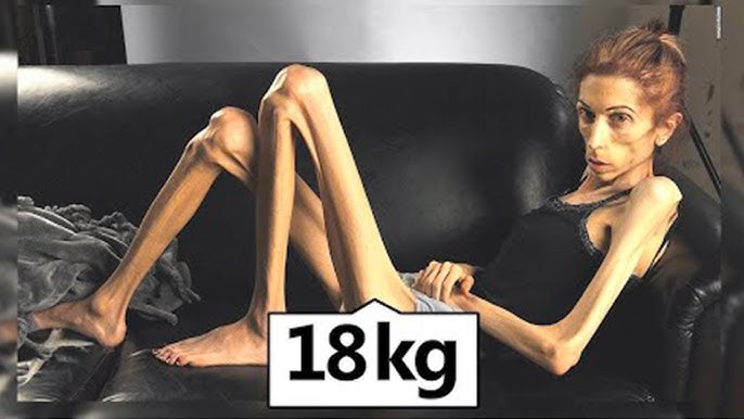 Is there a real thinnest guy in the world record? (Get the true facts about this title)