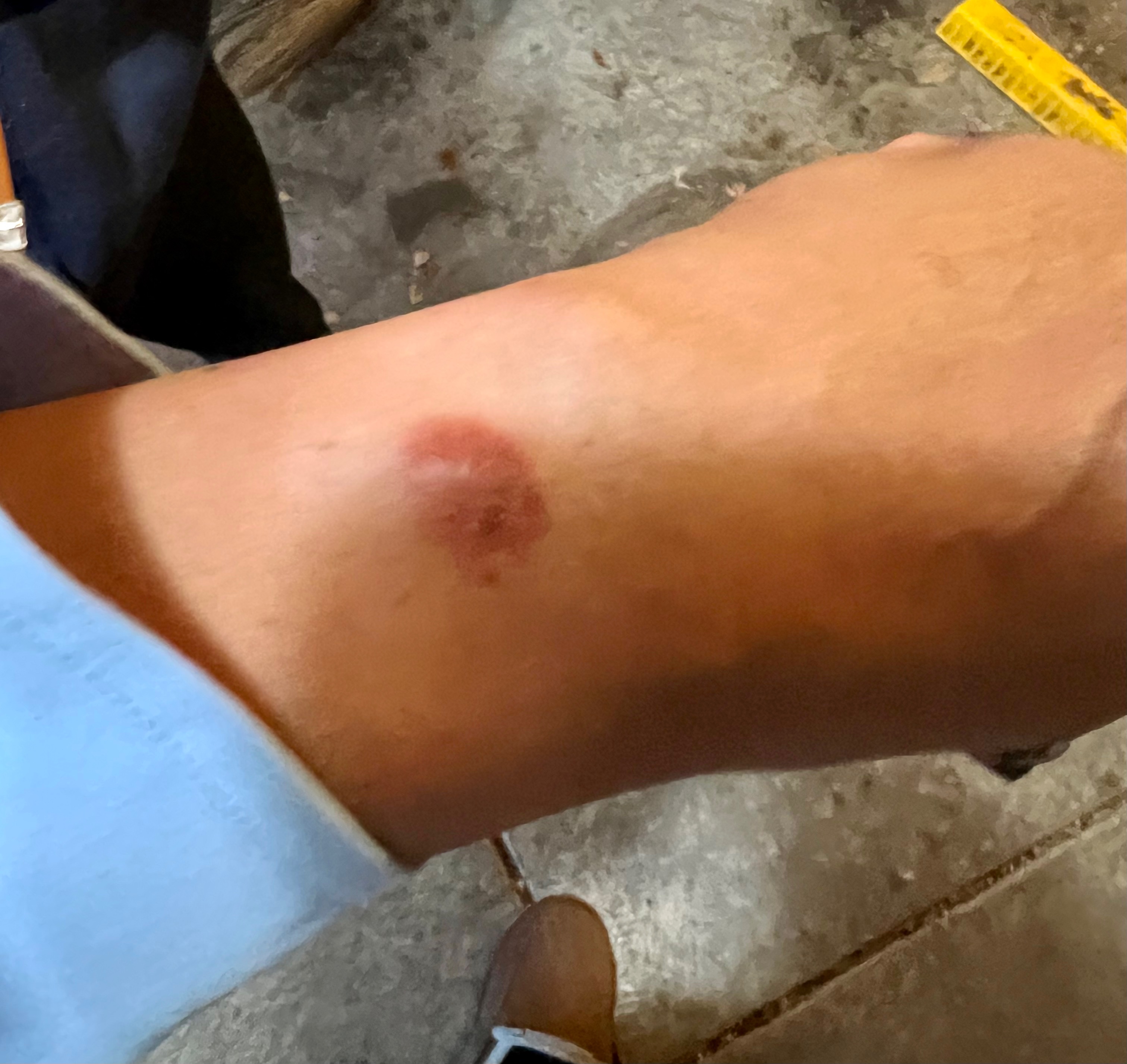 apple watch burn 2018 (Reports?)