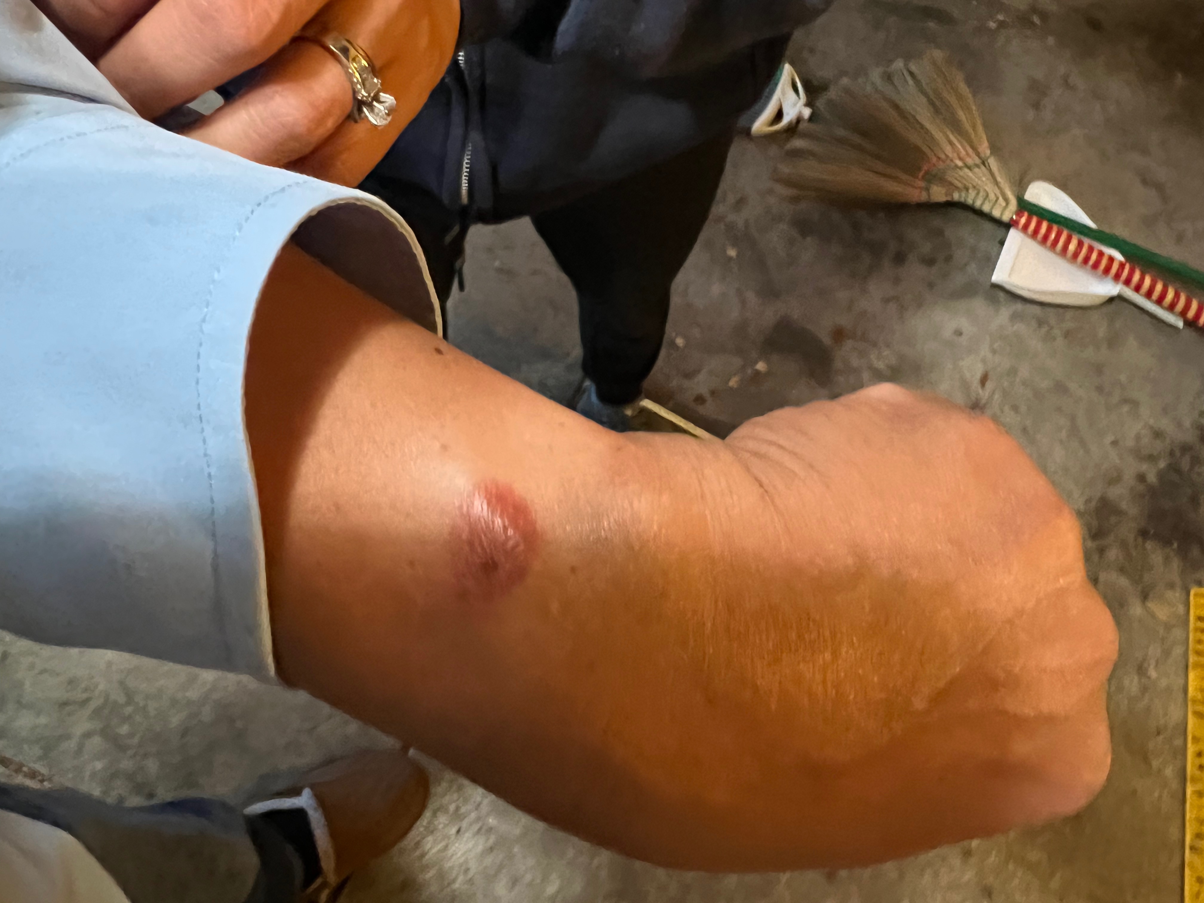 apple watch burn 2018 (Reports?)