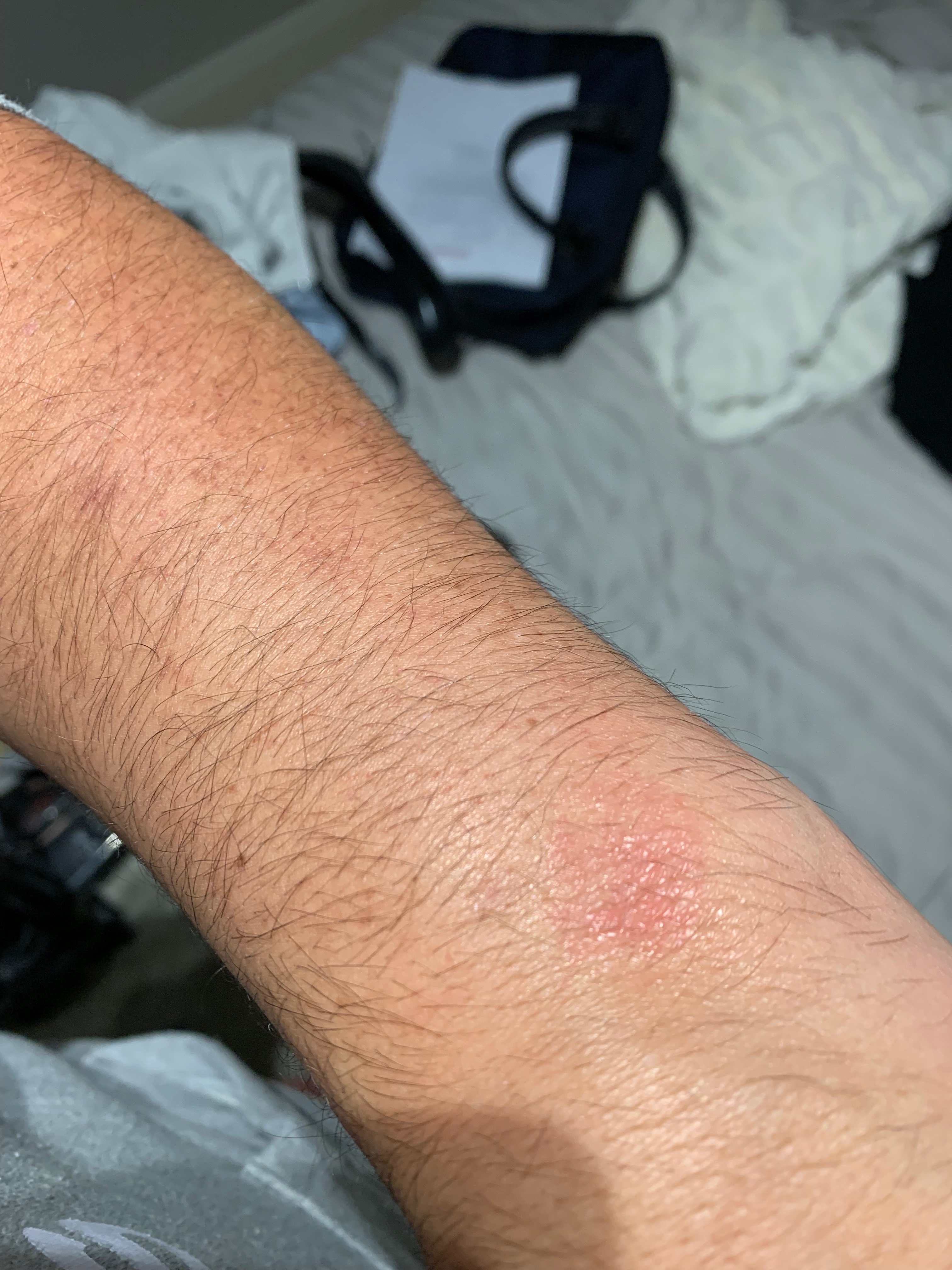 apple watch burn 2018 (Reports?)
