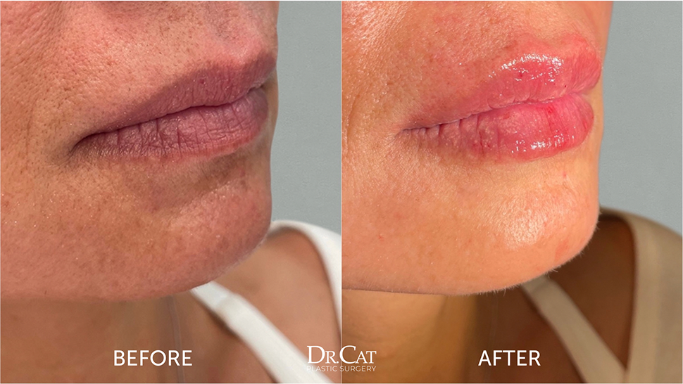 JT Lips Cost Before and After Prices Plus Best Time for Treatment