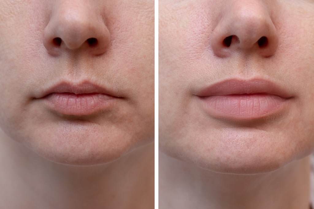 JT Lips Cost Before and After Prices Plus Best Time for Treatment
