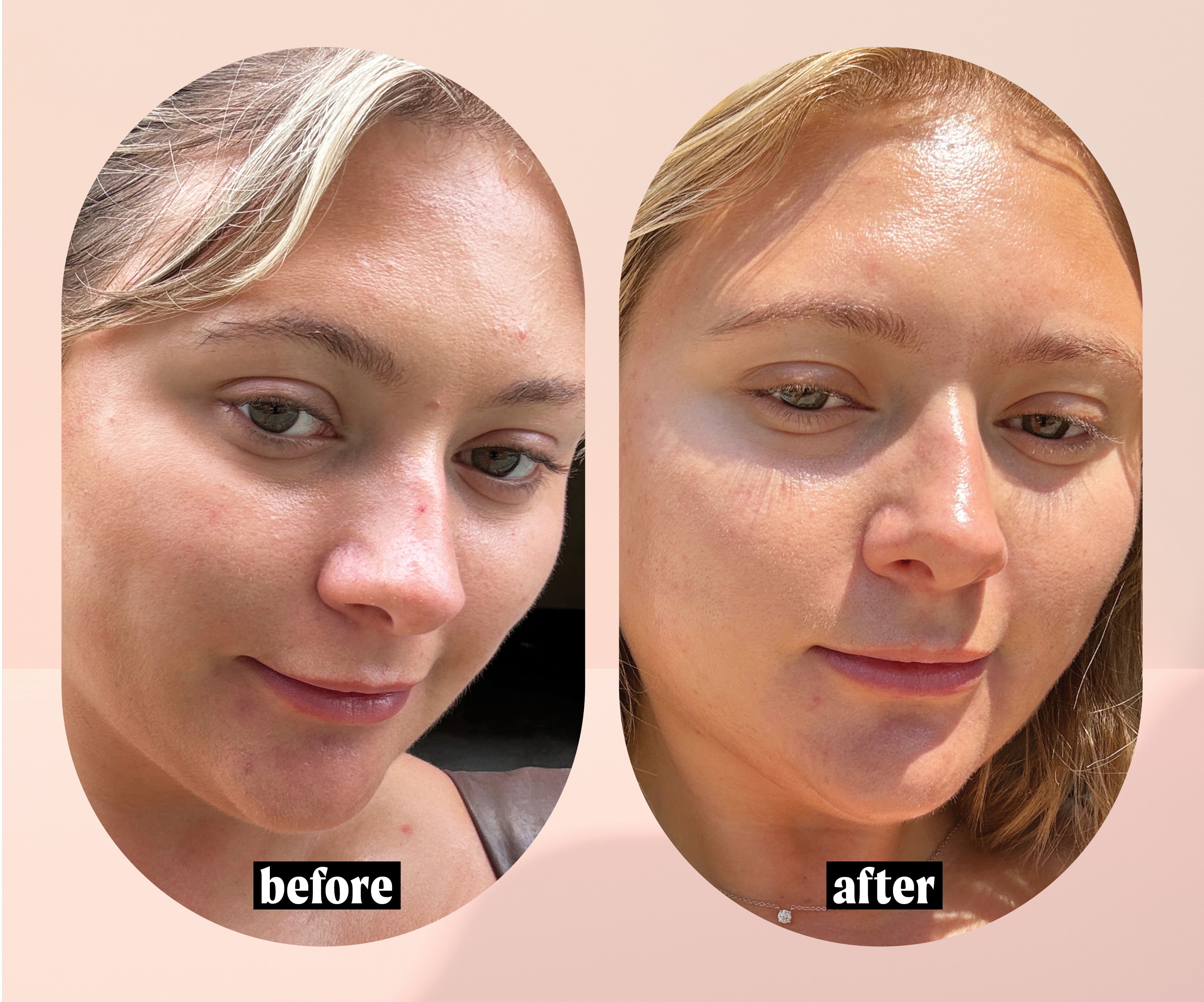 PCA Facial Cost Saving Tips (Get Glow Without Breaking Bank)